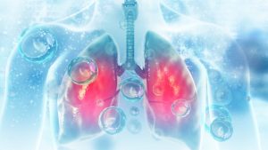 Une innovation dans le domaine de la BPCO pourrait empêcher les patients atteints de covid d'avoir recours aux respirateurs